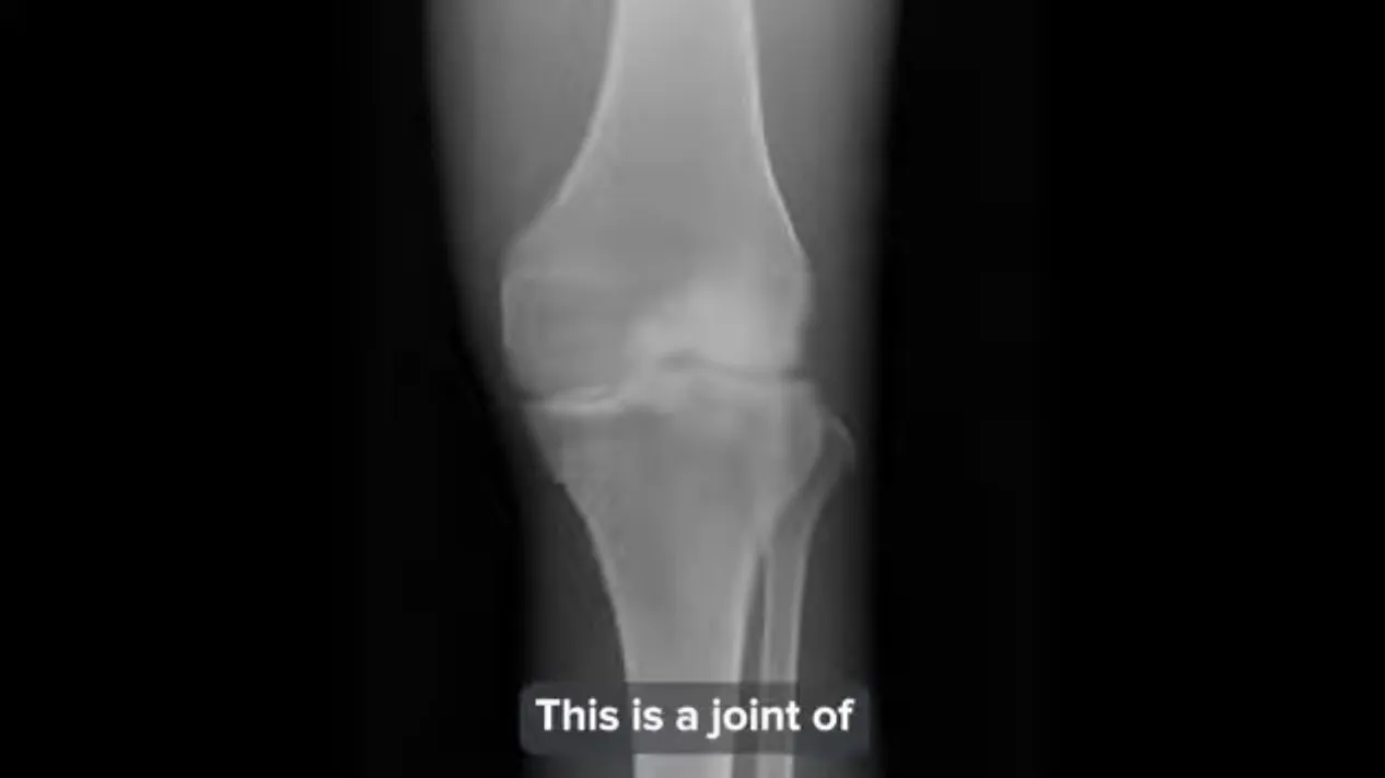 Harvard study reveals hidden cause of knee pain and cartilage loss in seniors